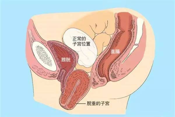 【產后修復】盆腔臟器脫垂，你有嗎？