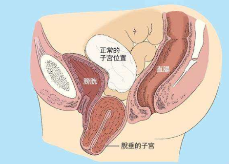 人們常說，產(chǎn)后女性做好盆底肌修復(fù)是關(guān)鍵，但盆腔器官的脫垂你也得注意