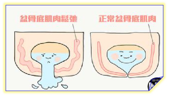 盆底康復(fù)治療怎么做，盆底肌修復(fù)常見的十大問題（中）