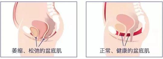 尿失禁治療儀器，不再詢問盆底康復治療有用嗎這類無意義問題