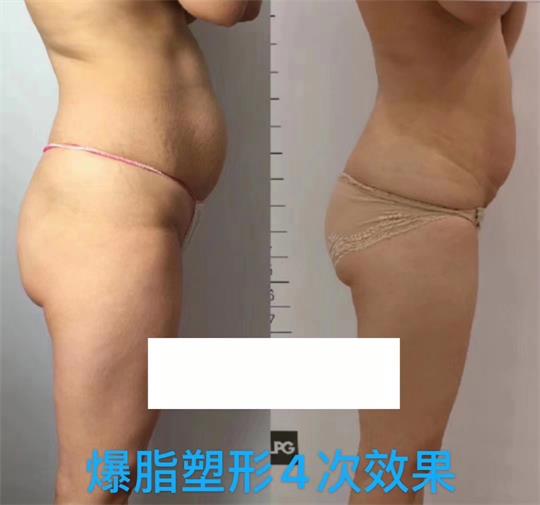 產(chǎn)后塑形美雕儀，生完孩子真的很難恢復(fù)身材？未必……