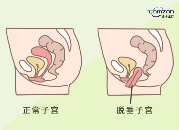 你害怕子宮脫垂嗎？盆底肌修復(fù)儀器來拯救你