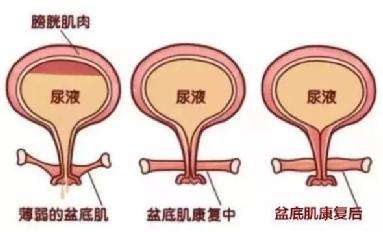 尿頻尿急尿不盡？或者可以試試盆底肌修復儀器電刺激