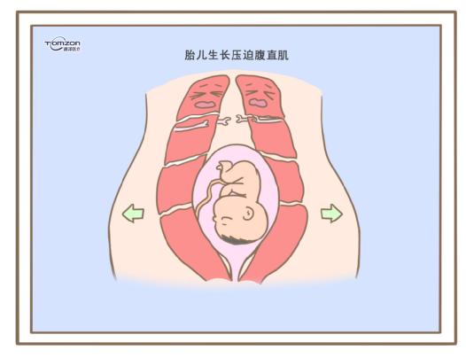 腹直肌分離可以使用盆底肌修復(fù)儀器嗎？