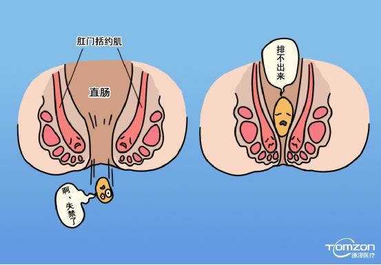 便秘跟盆底肌有什么關(guān)系，能用盆底肌修復儀器治療嗎？