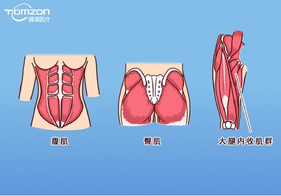 凱格爾運動該怎么做？盆底肌修復(fù)儀器效果會更好嗎？